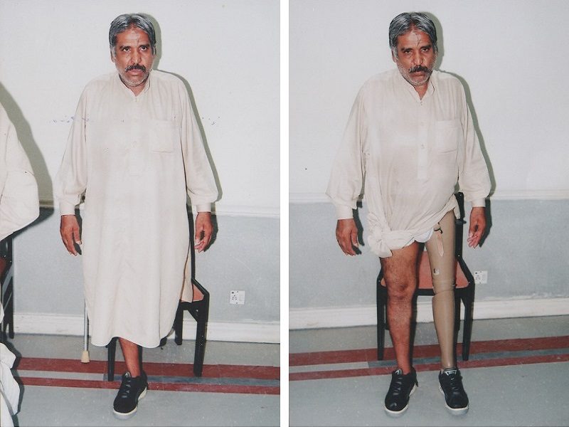 Artificial Limb Fitting