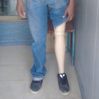 Implantation of Artificial Limbs Program
